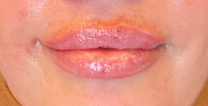 BLANK LIP FILLER B&A’S – 10